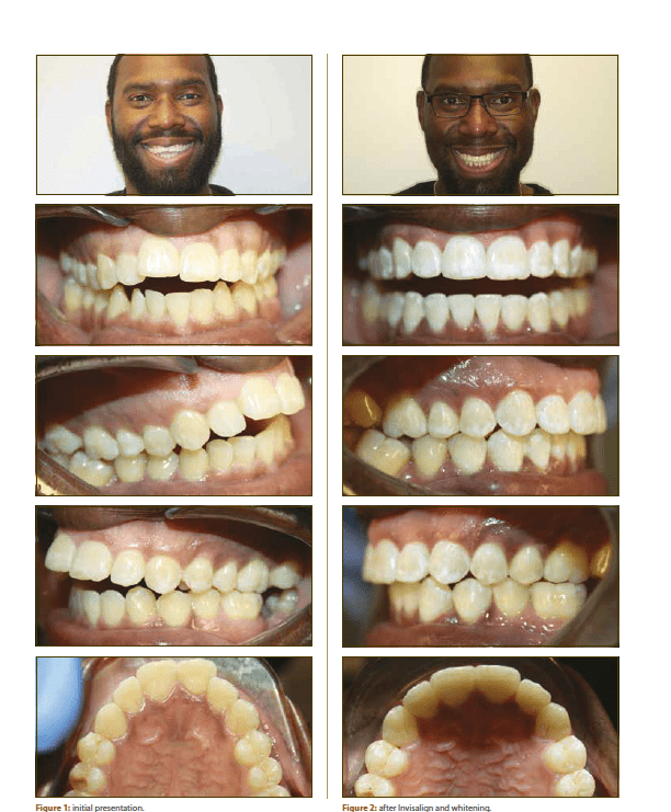 Clear Aligners results